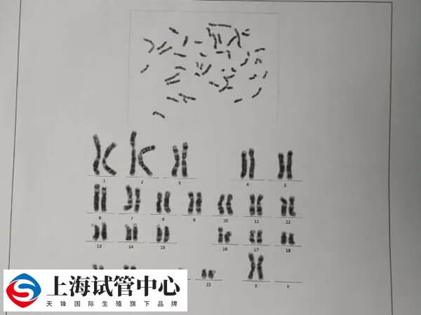 染色体sy1192缺失可能出现少精子症